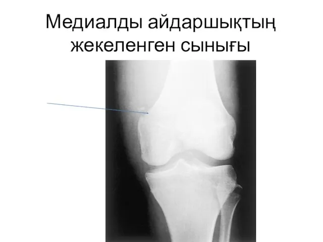 Медиалды айдаршықтың жекеленген сынығы