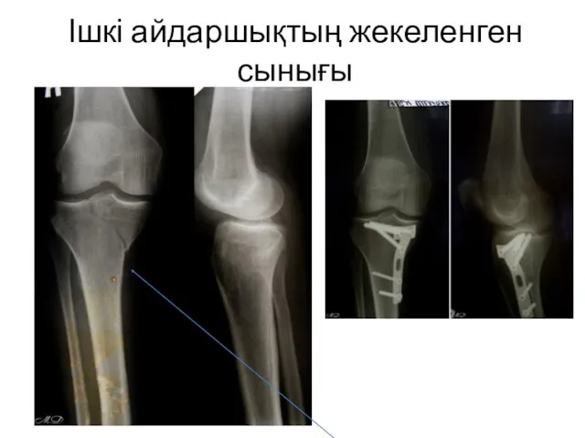 Ішкі айдаршықтың жекеленген сынығы