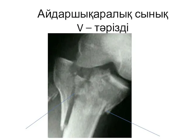 Айдаршықаралық сынық V – тәрізді