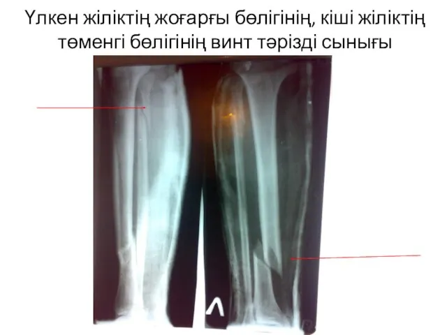 Үлкен жіліктің жоғарғы бөлігінің, кіші жіліктің төменгі бөлігінің винт тәрізді сынығы