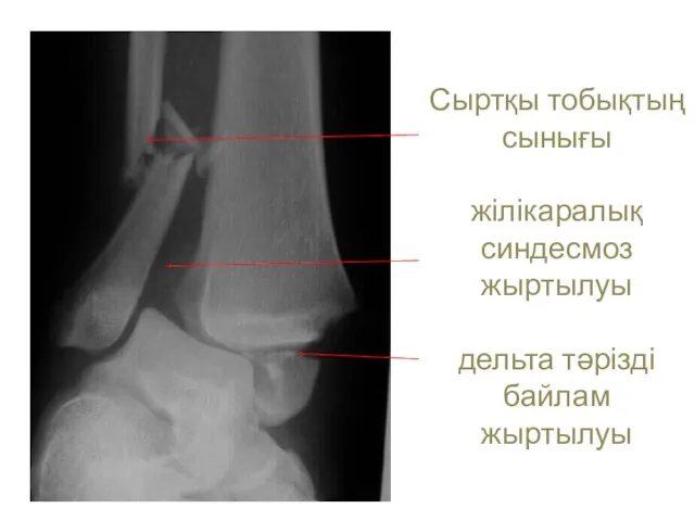 Сыртқы тобықтың сынығы жілікаралық синдесмоз жыртылуы дельта тәрізді байлам жыртылуы