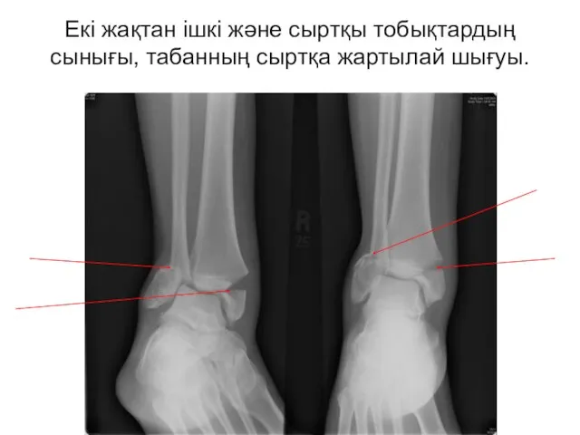 Екі жақтан ішкі және сыртқы тобықтардың сынығы, табанның сыртқа жартылай шығуы.