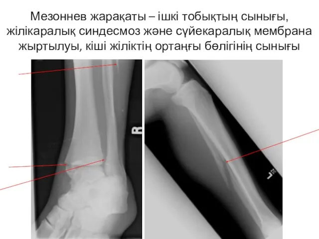 Мезоннев жарақаты – ішкі тобықтың сынығы, жілікаралық синдесмоз және сүйекаралық