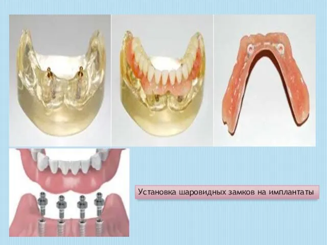 Установка шаровидных замков на имплантаты