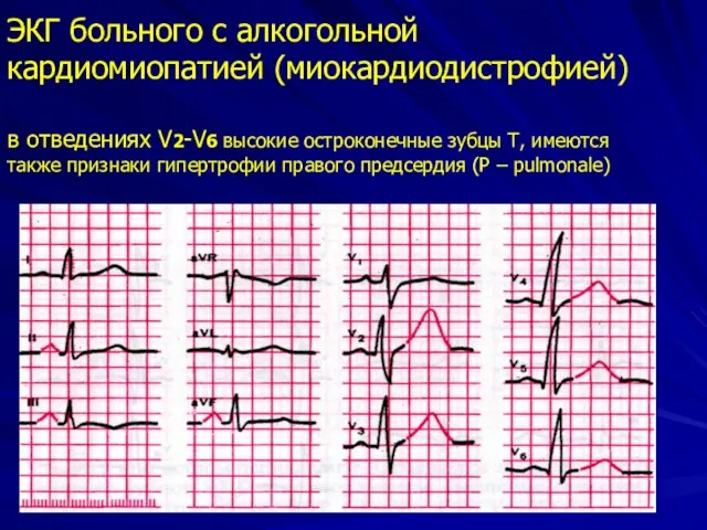 ЭКГ больного с алкогольной кардиомиопатией (миокардиодистрофией) в отведениях V2-V6 высокие