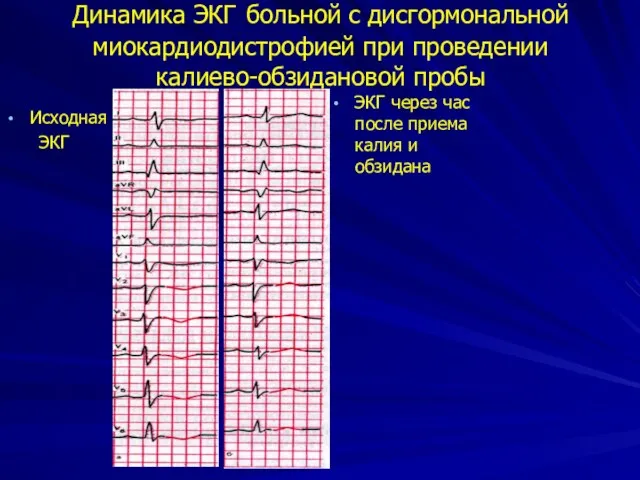 Динамика ЭКГ больной с дисгормональной миокардиодистрофией при проведении калиево-обзидановой пробы