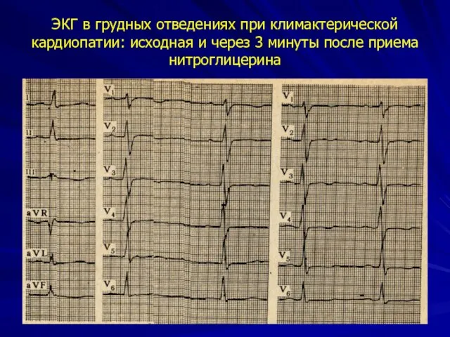 ЭКГ в грудных отведениях при климактерической кардиопатии: исходная и через 3 минуты после приема нитроглицерина