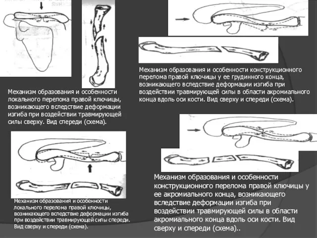 Механизм образования и особенности локального перелома правой ключицы, возникающего вследствие