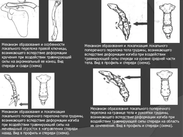 Механизм образования и особенности локального перелома правой ключицы, возникающего вследствие