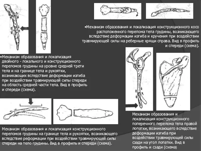 Механизм образования и локализация двойного - локального и конструкционного переломов