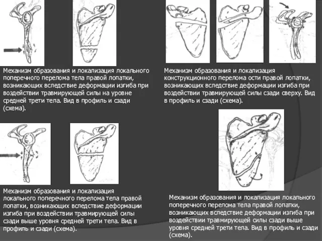 Механизм образования и локализация локального поперечного перелома тела правой лопатки,