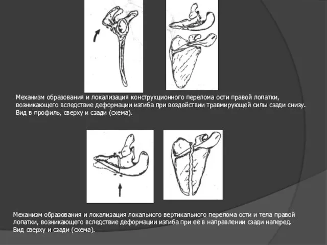 Механизм образования и локализация конструкционного перелома ости правой лопатки, возникающего