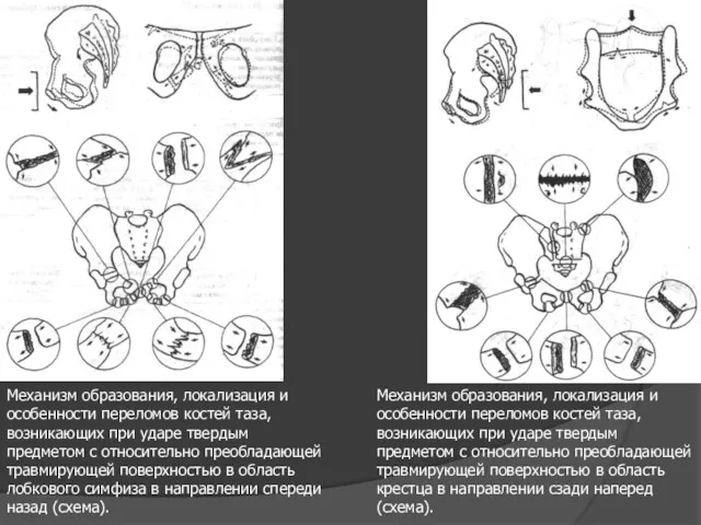 Механизм образования, локализация и особенности переломов костей таза, возникающих при