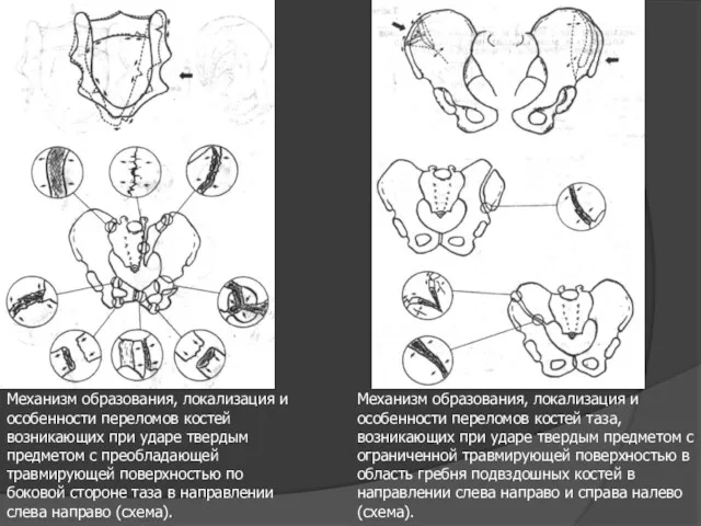 Механизм образования, локализация и особенности переломов костей возникающих при ударе