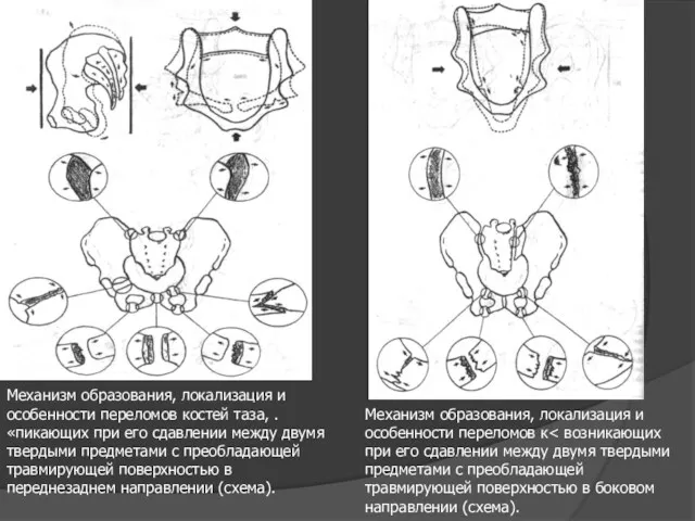 Механизм образования, локализация и особенности переломов костей таза, . «пикающих