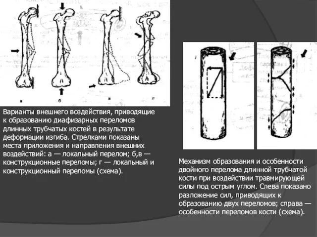 Варианты внешнего воздействия, приводящие к образованию диафизарных переломов длинных трубчатых