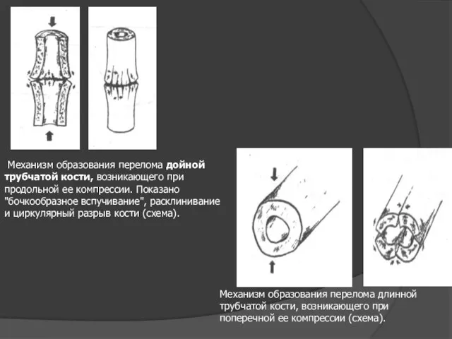 Механизм образования перелома дойной трубчатой кости, возникающего при продольной ее