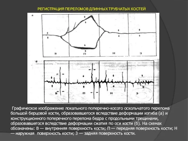 РЕГИСТРАЦИЯ ПЕРЕЛОМОВ ДЛИННЫХ ТРУБЧАТЫХ КОСТЕЙ Графическое изображение локального поперечно-косого оскольчатого