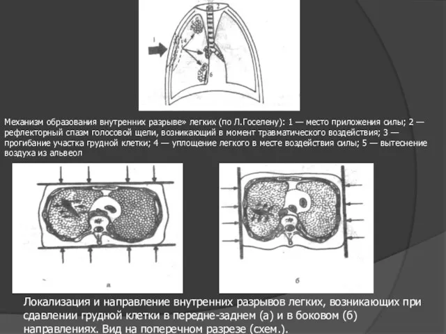 Механизм образования внутренних разрыве» легких (по Л.Госелену): 1 — ме­сто