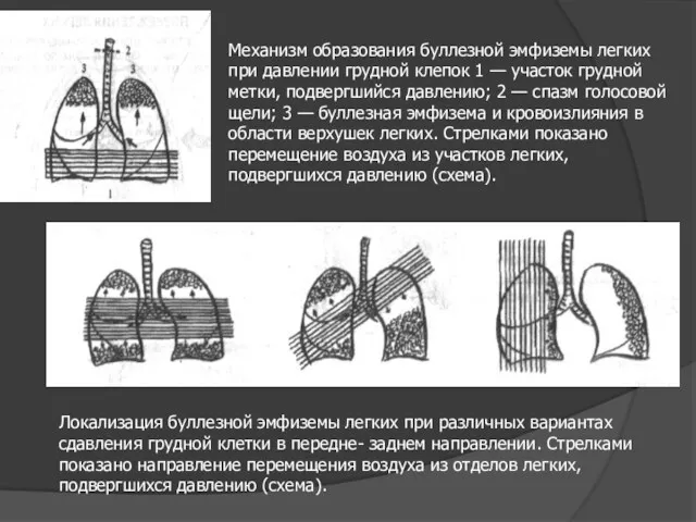 Механизм образования буллезной эмфиземы легких при давлении грудной клепок 1