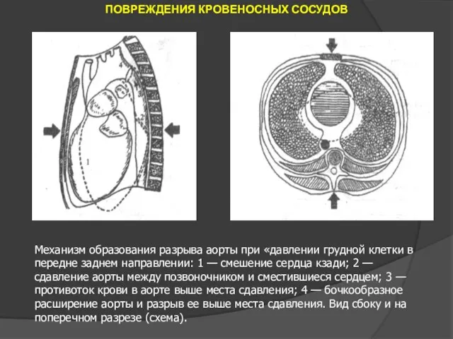 ПОВРЕЖДЕНИЯ КРОВЕНОСНЫХ СОСУДОВ Механизм образования разрыва аорты при «давлении грудной