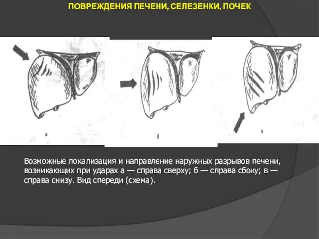 ПОВРЕЖДЕНИЯ ПЕЧЕНИ, СЕЛЕЗЕНКИ, ПОЧЕК Возможные локализация и направление наружных разрывов