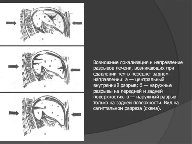 Возможные локализация и направление разрывов печени, возникающих при сдавлении тем