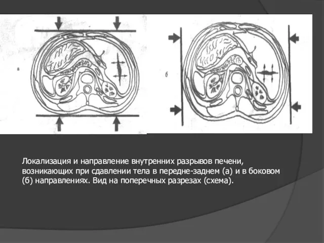 Локализация и направление внутренних разрывов печени, возникающих при сдавлении тела