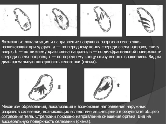 Возможные локализация и направление наружных разрывов селезенки, возникающих при ударах: