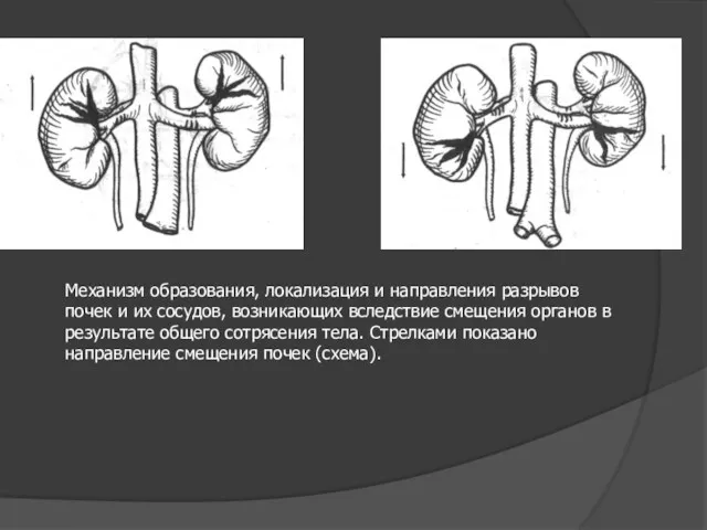 Механизм образования, локализация и направления разрывов почек и их сосудов,