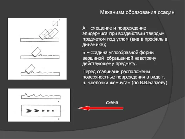 Механизм образования ссадин А – смещение и повреждение эпидермиса при