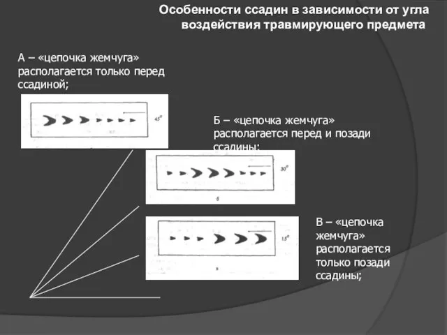 Особенности ссадин в зависимости от угла воздействия травмирующего предмета А