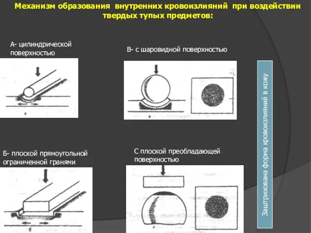 Механизм образования внутренних кровоизлияний при воздействии твердых тупых предметов: А-