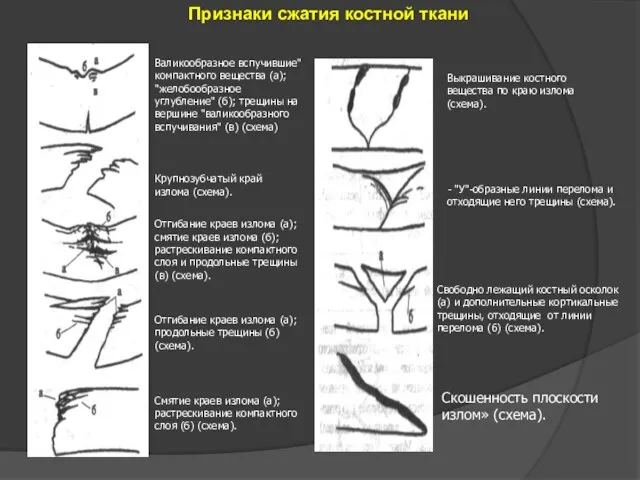 Признаки сжатия костной ткани Валикообразное вспучившие" компактного вещества (а); "желобообразное