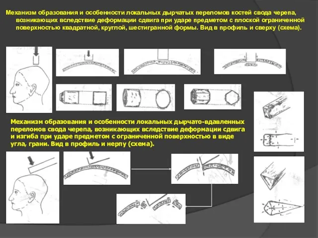 Механизм образования и особенности локальных дырчатых переломов костей свода черепа,