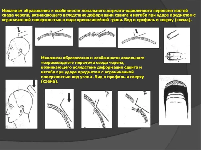 Механизм образования и особенности локального дырчато-вдавленного перелома костей свода черепа,