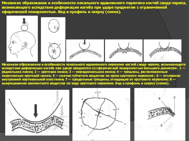 Механизм образования и особенности локального вдавленного перелома костей свода черепа,