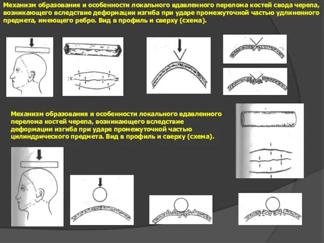 Механизм образования и особенности локального вдавленного перелома костей свода черепа,