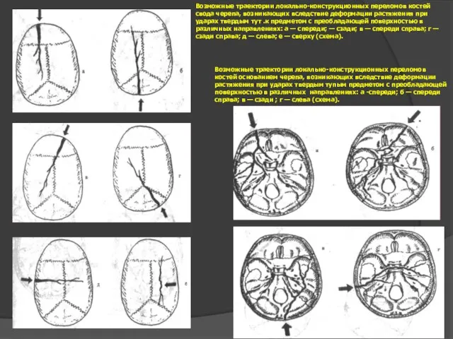 Схема переломов черепа 6 Возможные траектории локально-конструкционных переломов костей свода