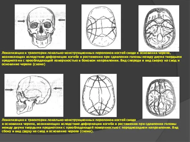 Локализация и траектории локально-конструкционных переломов костей свода и основания черепа,