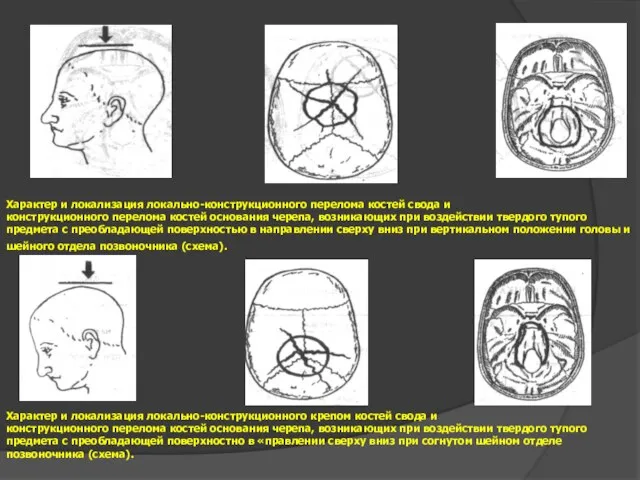 Характер и локализация локально-конструкционного перелома костей свода и конструкционного перелома