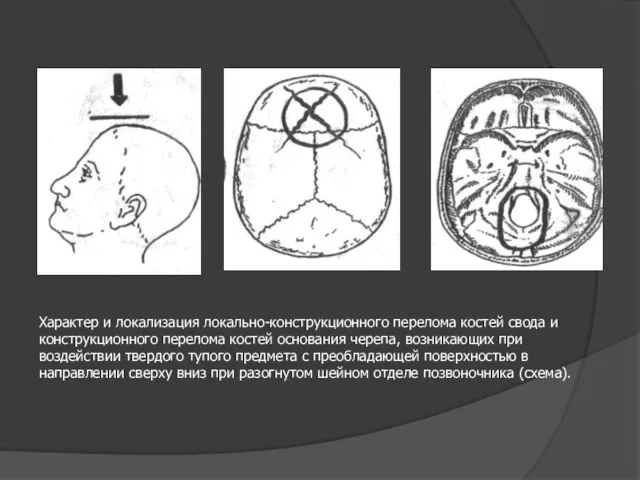 Характер и локализация локально-конструкционного перелома костей свода и конструкционного перелома