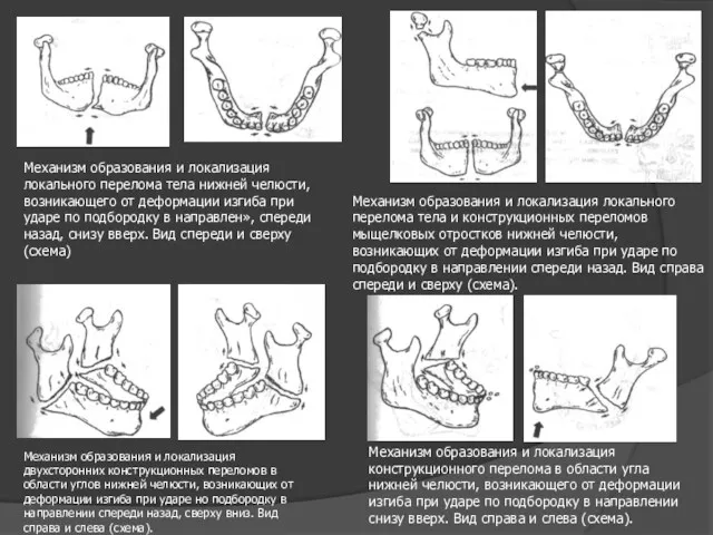 Механизм образования и локализация локального перелома тела нижней челюсти, возникающего
