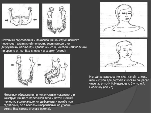 Механизм образования и локализация конструкционного перелома тела нижней челюсти, возникающего