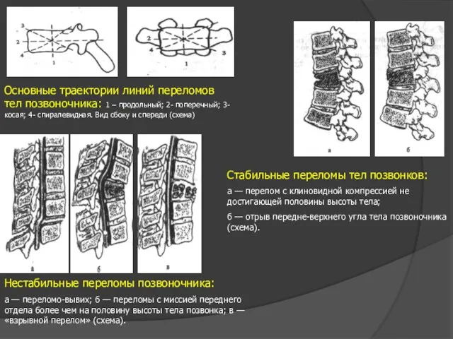 Основные траектории линий переломов тел позвоночника: 1 – продольный; 2-