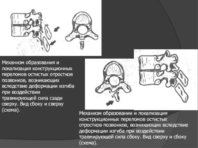 Механизм образования и локализация конструкционных переломов остистых отростков позвонков, возникающих