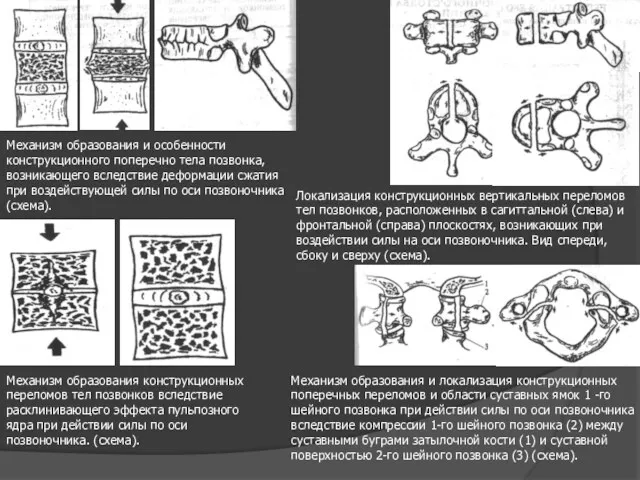 Механизм образования и особенности конструкционного поперечно тела позвонка, возникающего вследствие