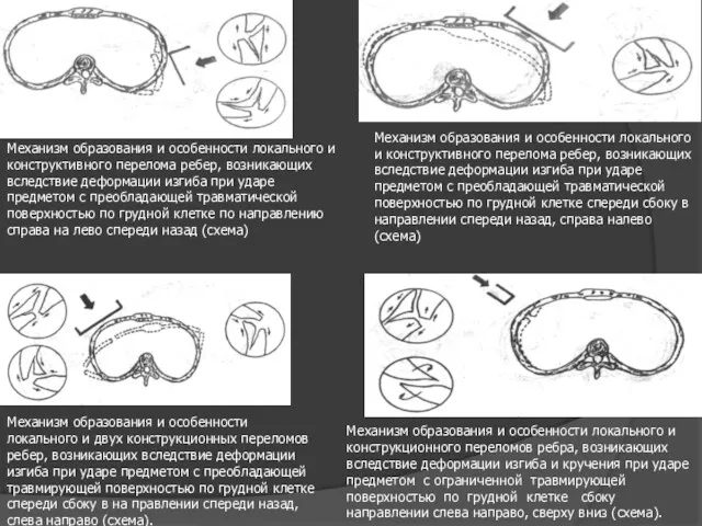Механизм образования и особенности локального и конструктивного перелома ребер, возникающих