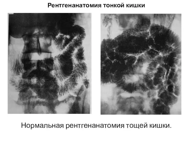 Нормальная рентгенанатомия тощей кишки. Рентгенанатомия тонкой кишки