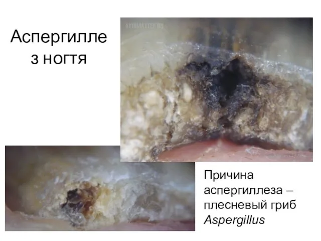 Аспергиллез ногтя Причина аспергиллеза – плесневый гриб Aspergillus